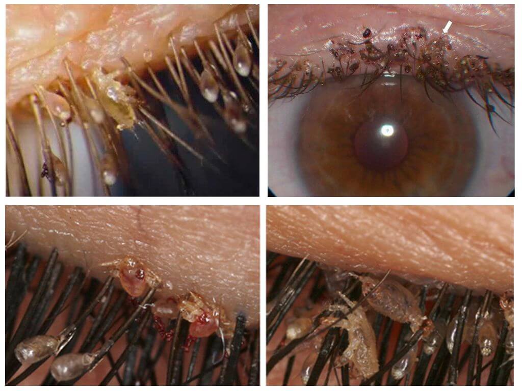 Poux sur les cils