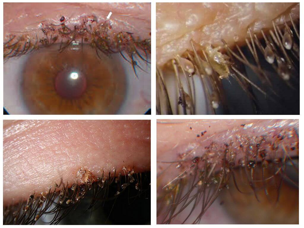 Poux sur les cils