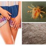 Les poux du pubis chez les femmes