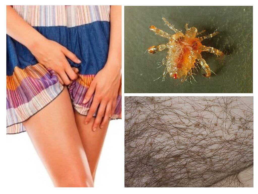 Les poux du pubis chez les femmes