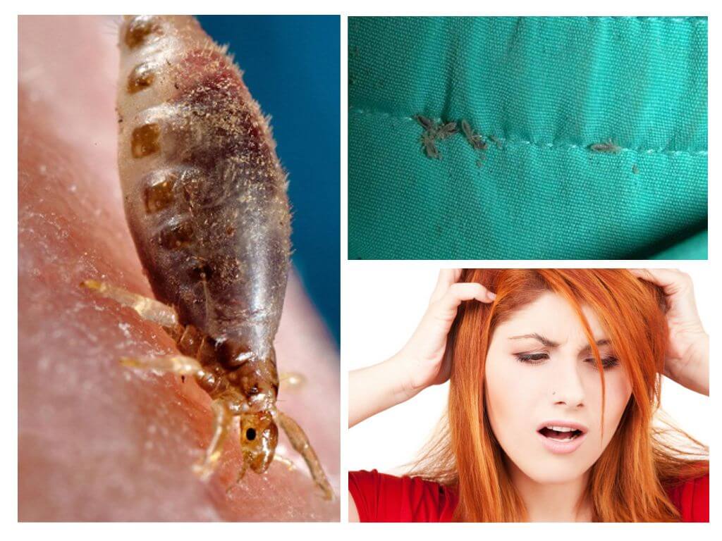 Infection par les poux