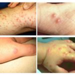 Effets de morsures