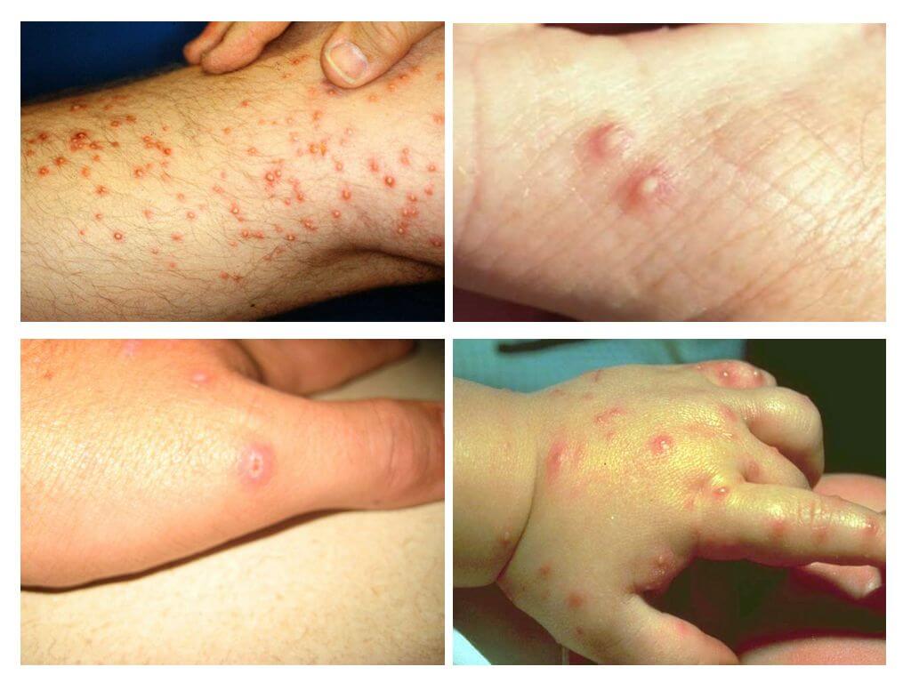 Effets de morsures