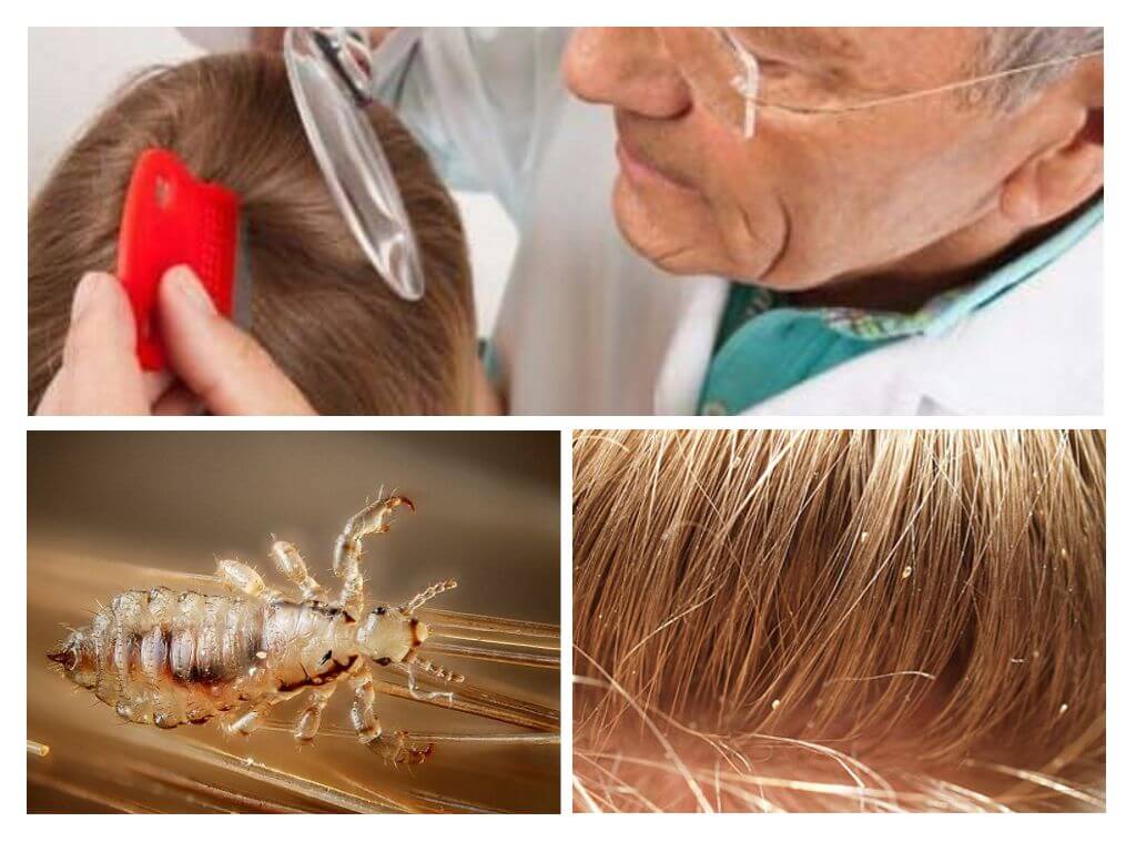 Examen des cheveux pour la pédiculose