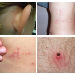 L'apparition de diverses morsures de parasites
