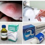 Premiers secours pour mordre