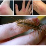 Morsure de mille-pattes