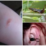 Morsure d'oreille