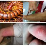 Morsure de mille-pattes
