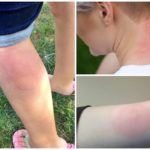 Allergie aux piqûres de moustiques