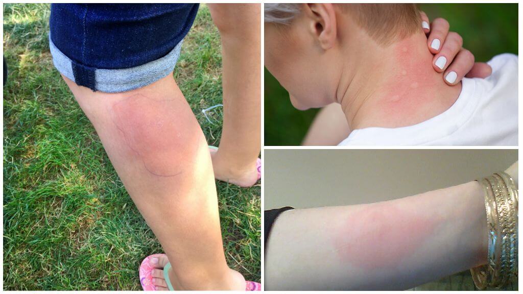 Allergie aux piqûres de moustiques