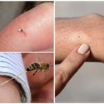 Piqûre d'abeille