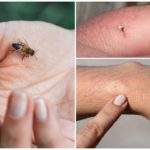 Abeille, sa morsure et sa piqûre