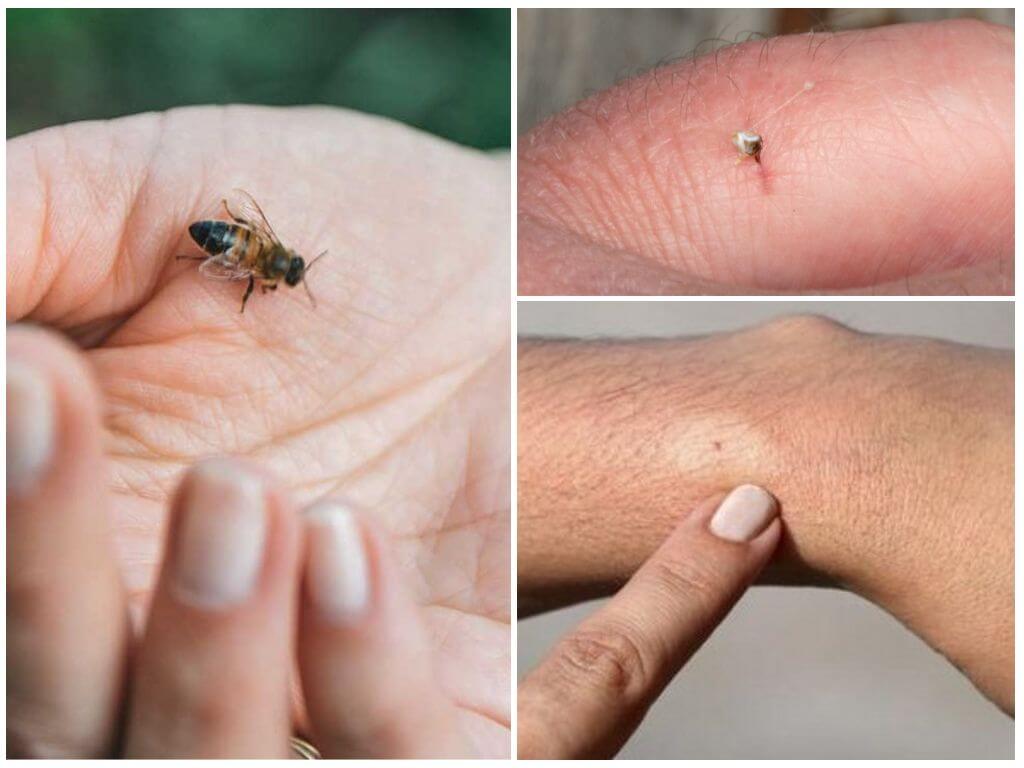 Abeille, sa morsure et sa piqûre