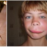 Effets d'une morsure de frelon