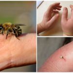 Mal de piqûre d'abeille