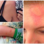 Réaction allergique aux piqûres de moustiques