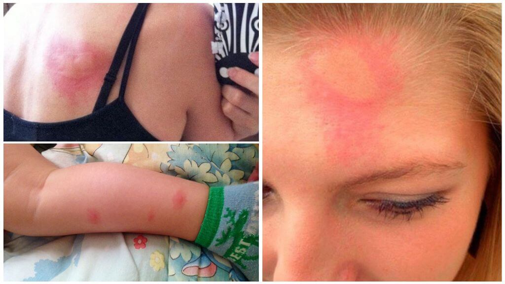 Réaction allergique aux piqûres de moustiques