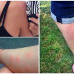 Réaction allergique aux piqûres de moustiques