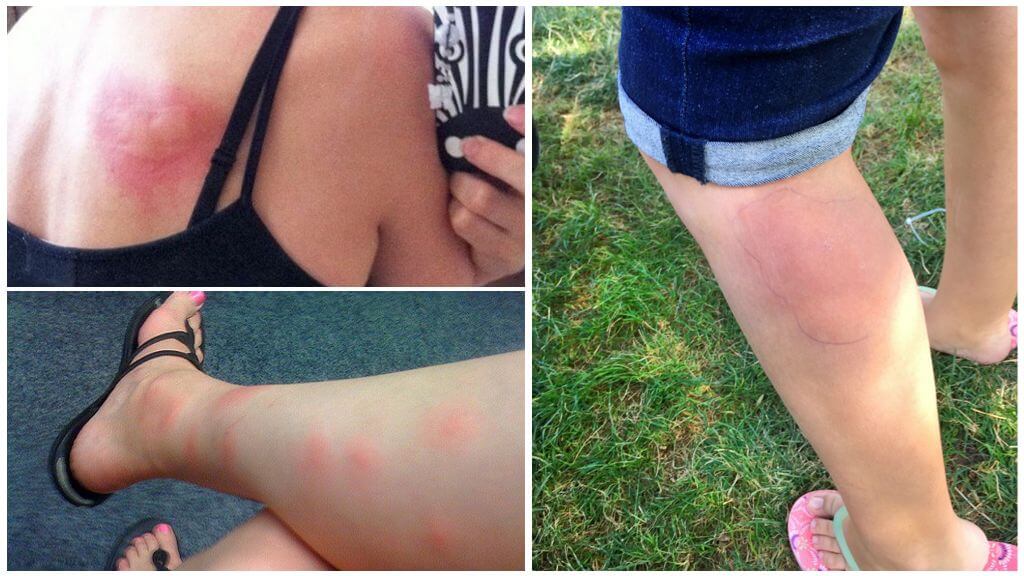 Réaction allergique aux piqûres de moustiques