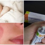 Contre-indications à l'utilisation de la pommade à l'hydrocortisone