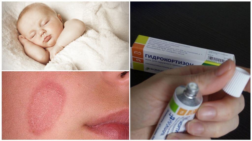 Contre-indications à l'utilisation de la pommade à l'hydrocortisone
