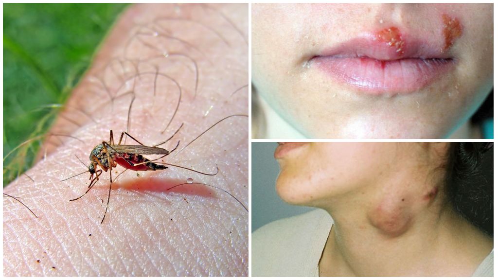 Paludisme et tularémie chez les moustiques