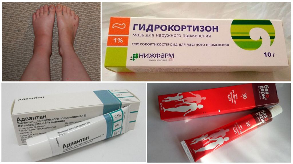 Traitement de l'oedème avec des médicaments hormonaux