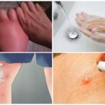 Premiers secours contre les piqûres de moustiques