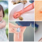 Premiers secours contre les piqûres de moustiques chez les enfants
