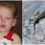 Les yeux gonflés d'un enfant d'une piqûre de moustique