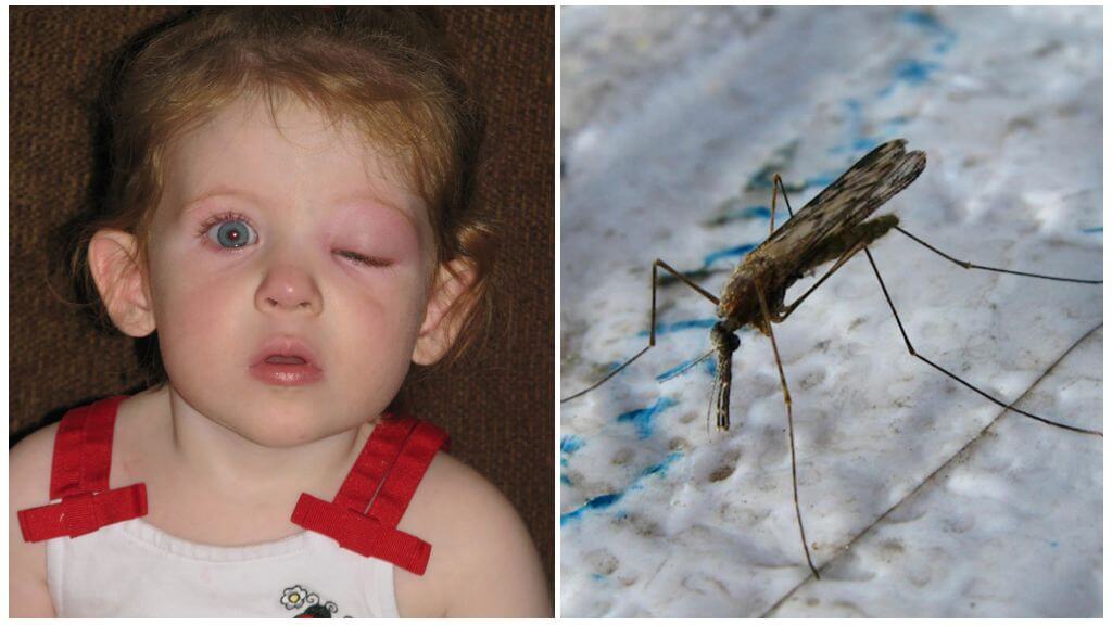 Les yeux gonflés d'un enfant d'une piqûre de moustique