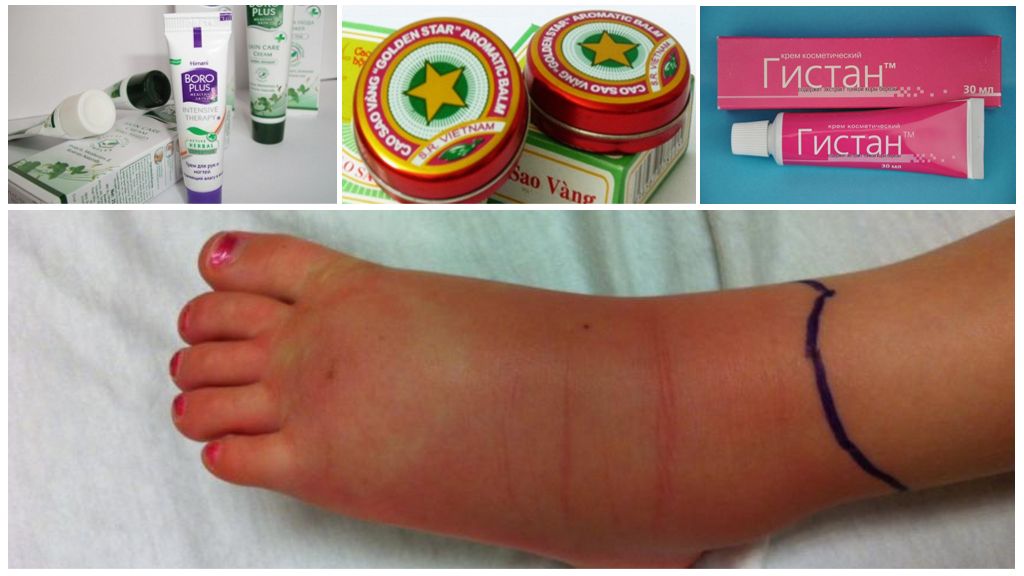 Traitement de l'enflure des jambes avec des remèdes naturels