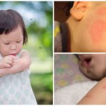 Les piqûres de moustiques chez les enfants