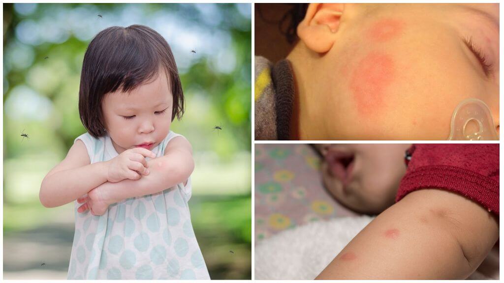 Les piqûres de moustiques chez les enfants