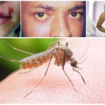 Effets possibles d'une piqûre de moustique