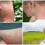 La réaction du corps aux piqûres d'insectes