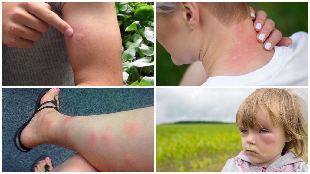 La réaction du corps aux piqûres d'insectes