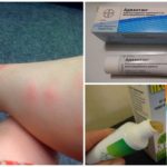 Remèdes contre les piqûres de moustiques