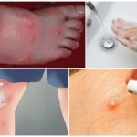 Actions pour blistering morsures de moustiques