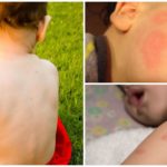 Les piqûres de moustiques chez les enfants