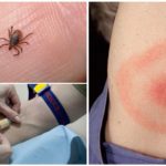 Test sanguin pour la borréliose après une morsure de tique