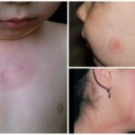 Borréliose chez les enfants