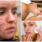 Traitement de la démodécie sur le visage d'une personne