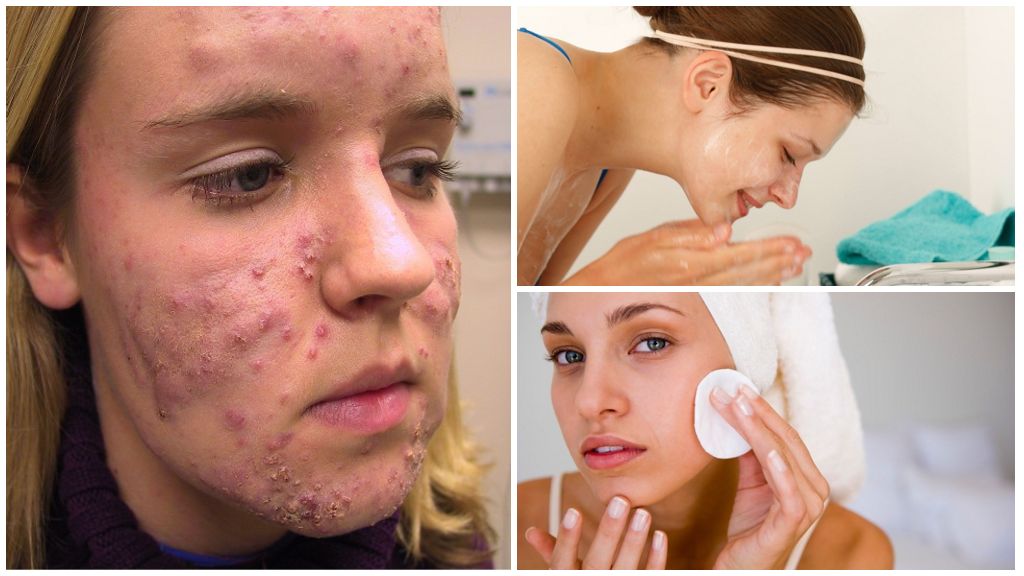 Traitement de la démodécie sur le visage d'une personne