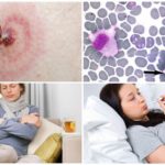 Ehrlichiose monocytaire chez l'homme