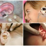 Enlever la mouche de l'oreille