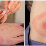 Maladies causées par les morsures de tiques