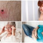 Premiers signes de maladies transmises par les tiques