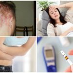 Causes de la démodécie du cuir chevelu